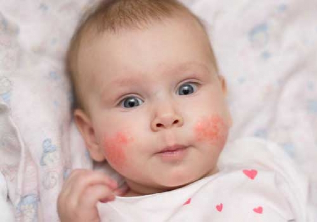 Bambino con dermatite atopica
